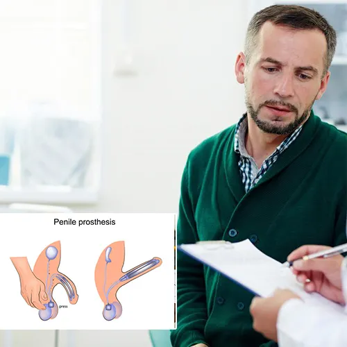 Why Choose a Penile Implant?